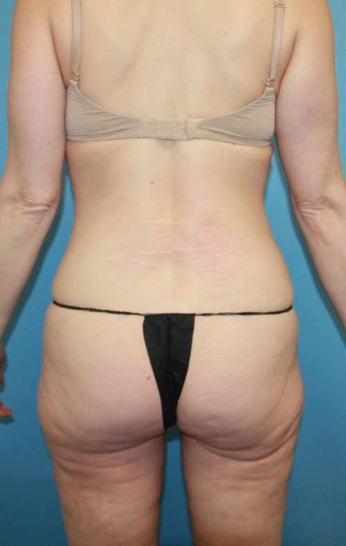 Plastic surgery patient results gallery - Dr. Cat Beverly Hills