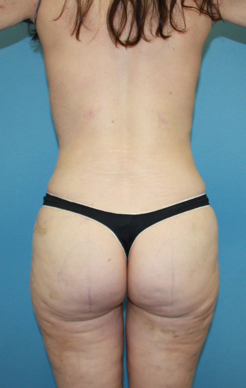 Plastic surgery patient results gallery - Dr. Cat Beverly Hills