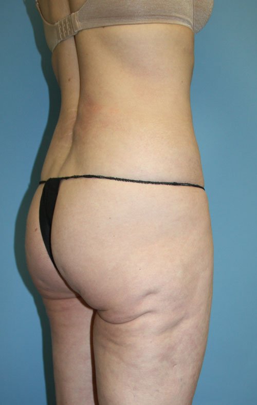 Plastic surgery patient results gallery - Dr. Cat Beverly Hills
