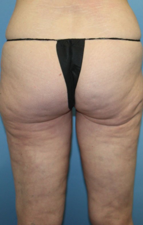 Plastic surgery patient results gallery - Dr. Cat Beverly Hills