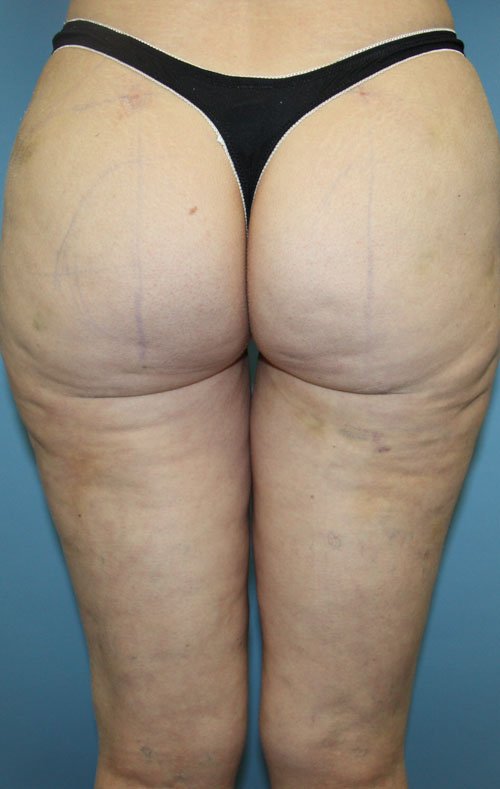 Plastic surgery patient results gallery - Dr. Cat Beverly Hills