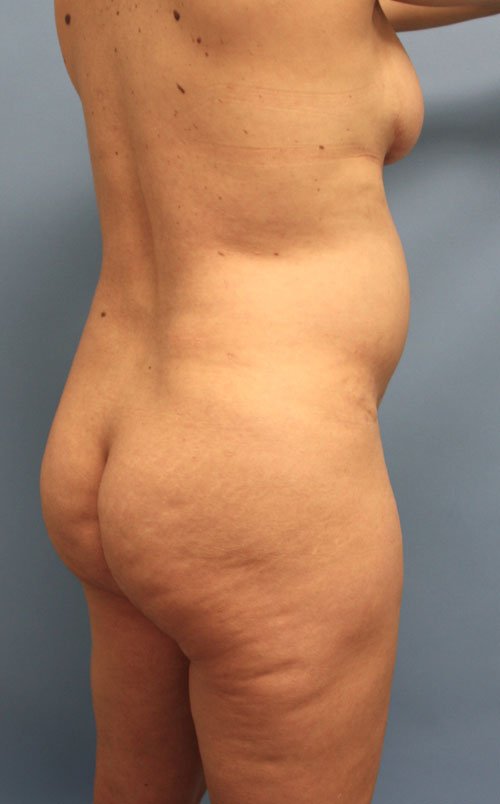 Plastic surgery patient results gallery - Dr. Cat Beverly Hills
