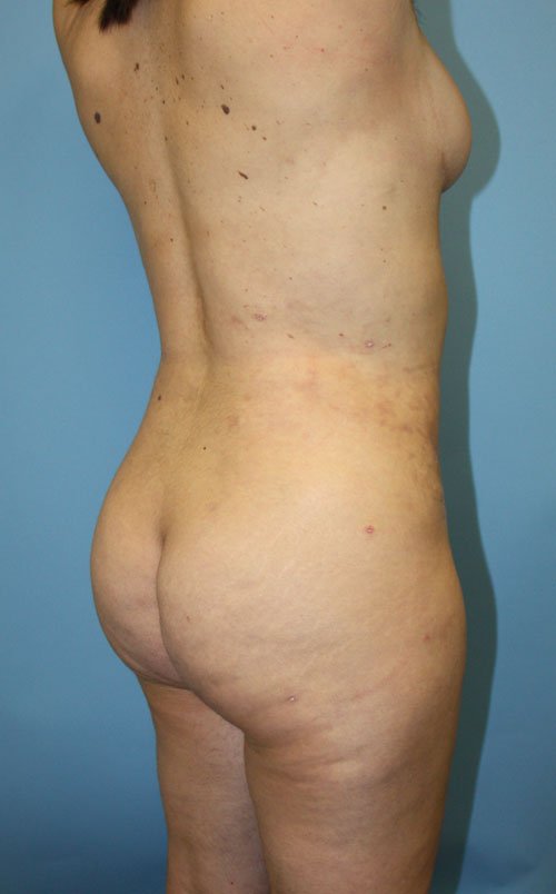 Plastic surgery patient results gallery - Dr. Cat Beverly Hills