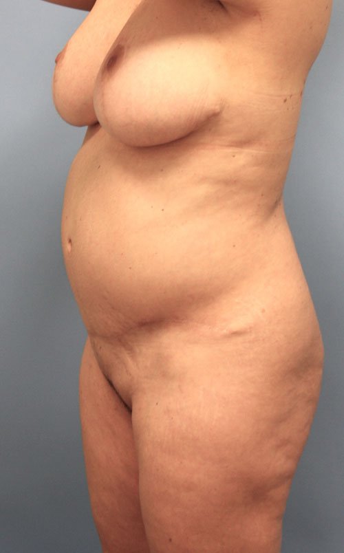 Plastic surgery patient results gallery - Dr. Cat Beverly Hills