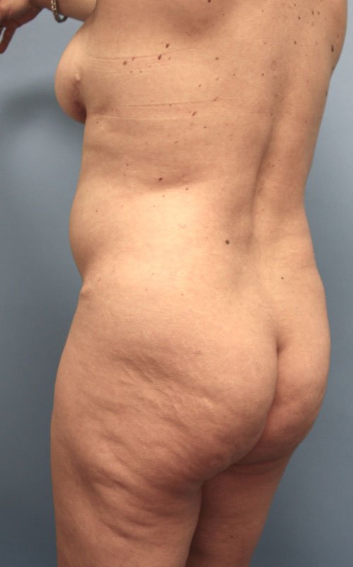 Plastic surgery patient results gallery - Dr. Cat Beverly Hills
