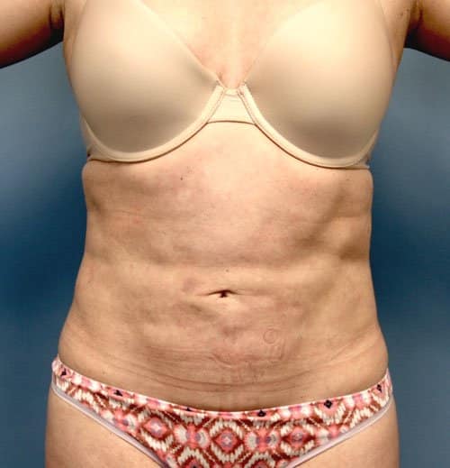 Plastic surgery patient results gallery - Dr. Cat Beverly Hills