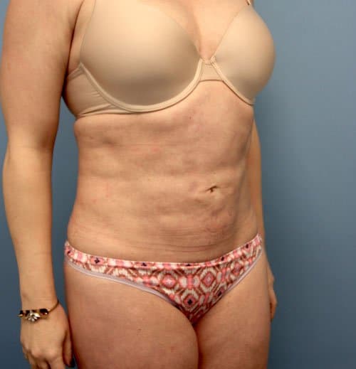 Plastic surgery patient results gallery - Dr. Cat Beverly Hills