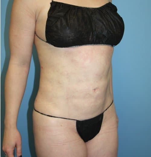 Plastic surgery patient results gallery - Dr. Cat Beverly Hills