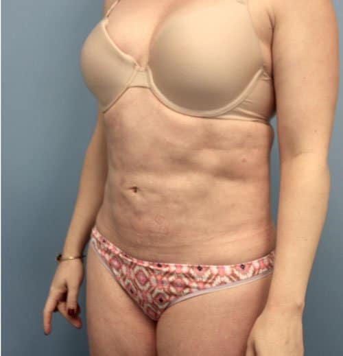 Plastic surgery patient results gallery - Dr. Cat Beverly Hills