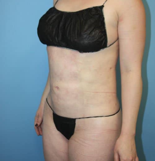 Plastic surgery patient results gallery - Dr. Cat Beverly Hills
