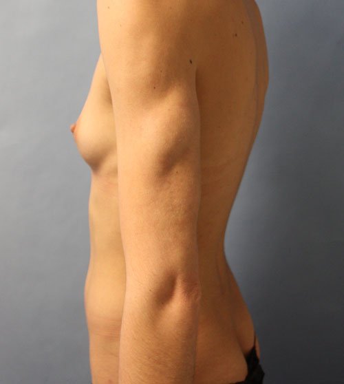 Plastic surgery patient results gallery - Dr. Cat Beverly Hills