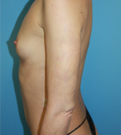 Plastic surgery patient results gallery - Dr. Cat Beverly Hills