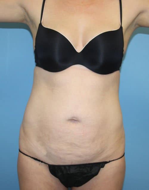 Plastic surgery patient results gallery - Dr. Cat Beverly Hills