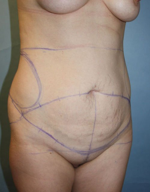 Plastic surgery patient results gallery - Dr. Cat Beverly Hills