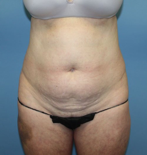 Plastic surgery patient results gallery - Dr. Cat Beverly Hills