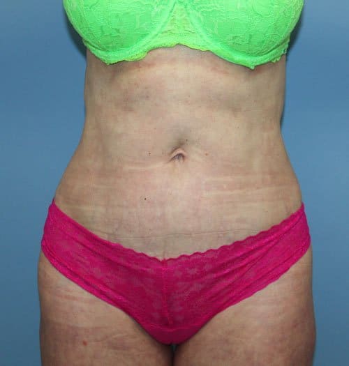 Plastic surgery patient results gallery - Dr. Cat Beverly Hills