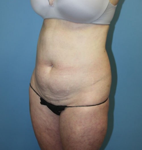 Plastic surgery patient results gallery - Dr. Cat Beverly Hills