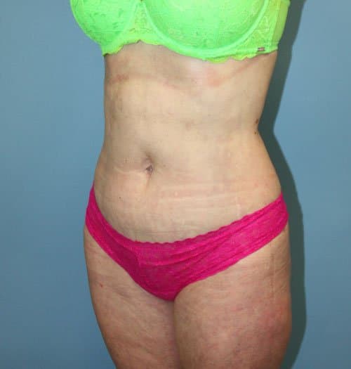 Plastic surgery patient results gallery - Dr. Cat Beverly Hills