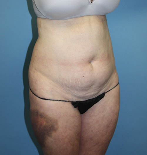 Plastic surgery patient results gallery - Dr. Cat Beverly Hills