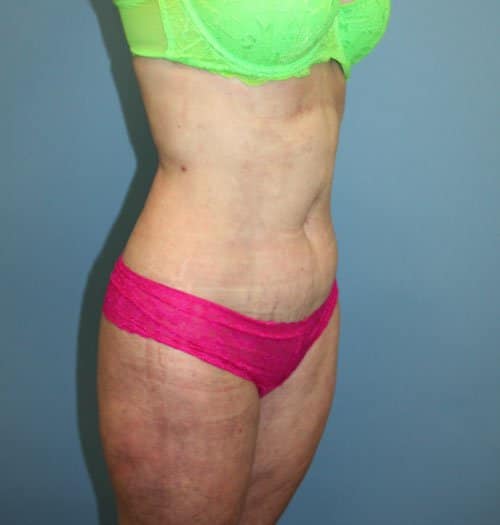 Plastic surgery patient results gallery - Dr. Cat Beverly Hills