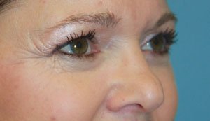 Plastic surgery patient results gallery - Dr. Cat Beverly Hills