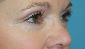 Plastic surgery patient results gallery - Dr. Cat Beverly Hills