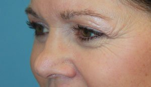 Plastic surgery patient results gallery - Dr. Cat Beverly Hills