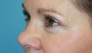 Plastic surgery patient results gallery - Dr. Cat Beverly Hills