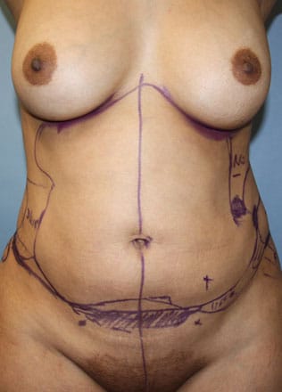 Plastic surgery patient results gallery - Dr. Cat Beverly Hills