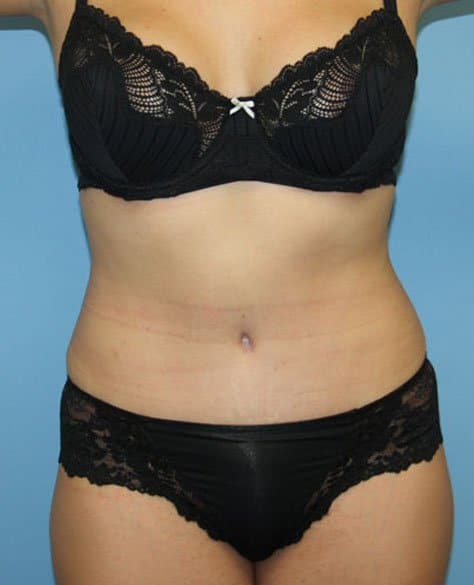 Plastic surgery patient results gallery - Dr. Cat Beverly Hills