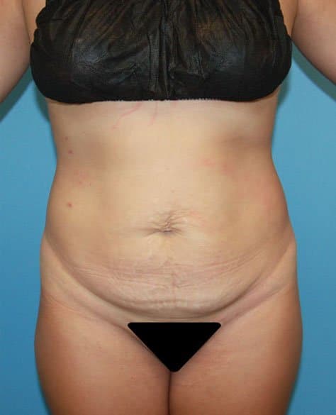 Plastic surgery patient results gallery - Dr. Cat Beverly Hills