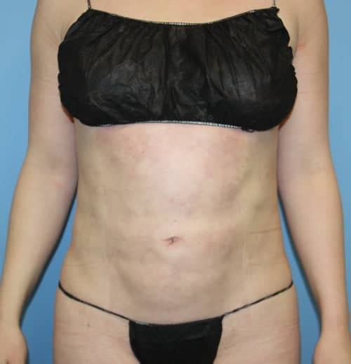Plastic surgery patient results gallery - Dr. Cat Beverly Hills
