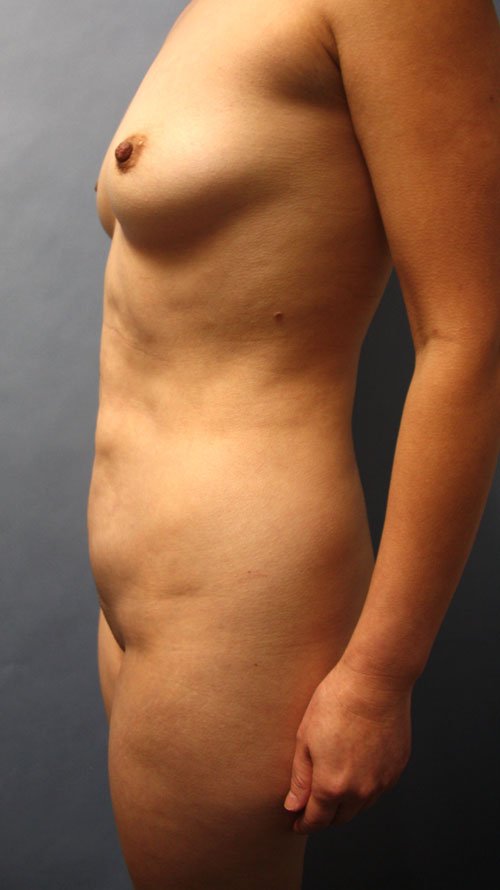 Plastic surgery patient results gallery - Dr. Cat Beverly Hills