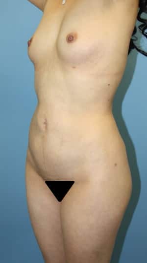 Plastic surgery patient results gallery - Dr. Cat Beverly Hills