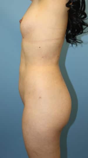 Plastic surgery patient results gallery - Dr. Cat Beverly Hills