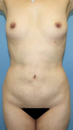 Plastic surgery patient results gallery - Dr. Cat Beverly Hills