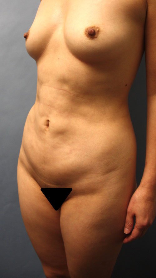 Plastic surgery patient results gallery - Dr. Cat Beverly Hills