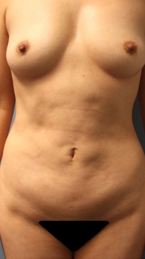Plastic surgery patient results gallery - Dr. Cat Beverly Hills
