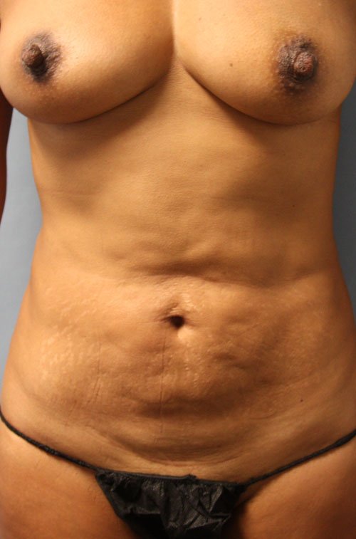 Plastic surgery patient results gallery - Dr. Cat Beverly Hills