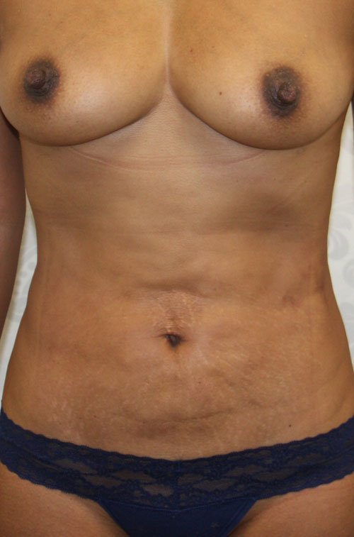 Plastic surgery patient results gallery - Dr. Cat Beverly Hills