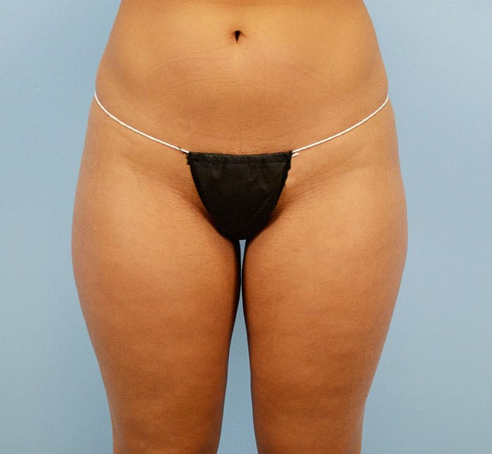 Plastic surgery patient results gallery - Dr. Cat Beverly Hills