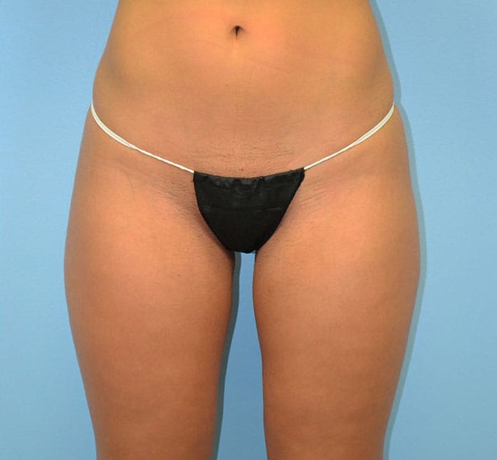 Plastic surgery patient results gallery - Dr. Cat Beverly Hills
