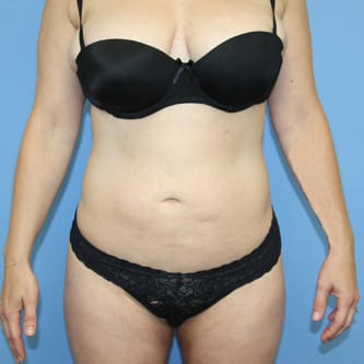 Plastic surgery patient results gallery - Dr. Cat Beverly Hills