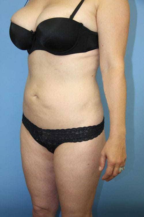 Plastic surgery patient results gallery - Dr. Cat Beverly Hills