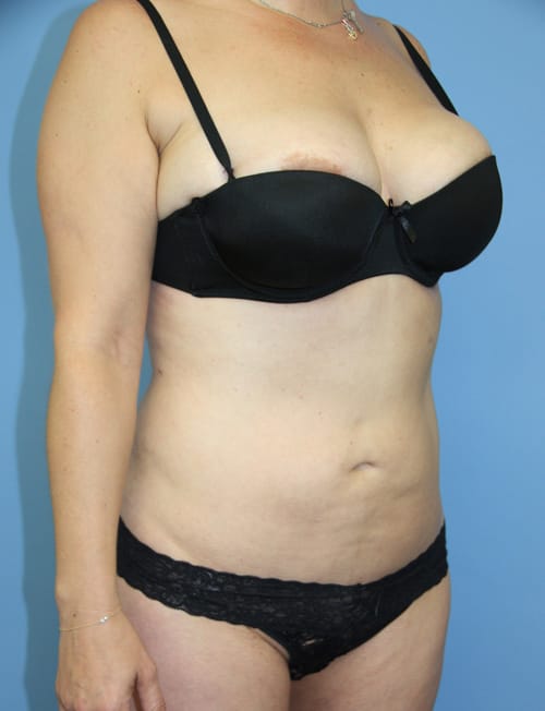 Plastic surgery patient results gallery - Dr. Cat Beverly Hills