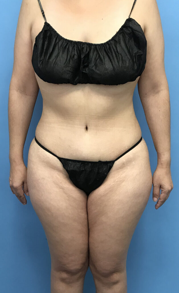 Case TTK-0572 after photo — Dr. Cat, Beverly Hills