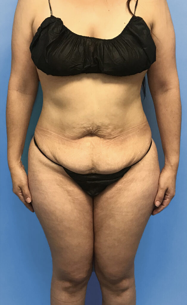 Case TTK-0572 before photo — Dr. Cat, Beverly Hills