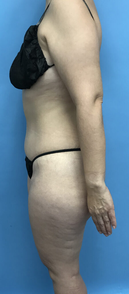 Case TTK-0572 after photo — Dr. Cat, Beverly Hills