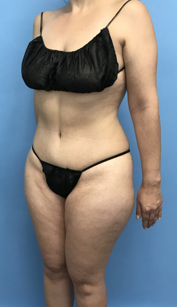Case TTK-0572 after photo — Dr. Cat, Beverly Hills
