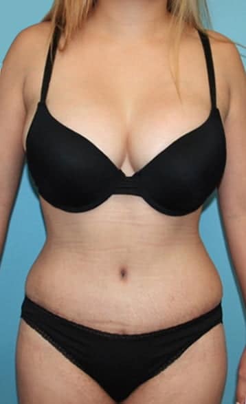 Plastic surgery patient results gallery - Dr. Cat Beverly Hills